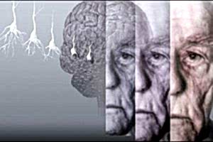 Симптомы деменции