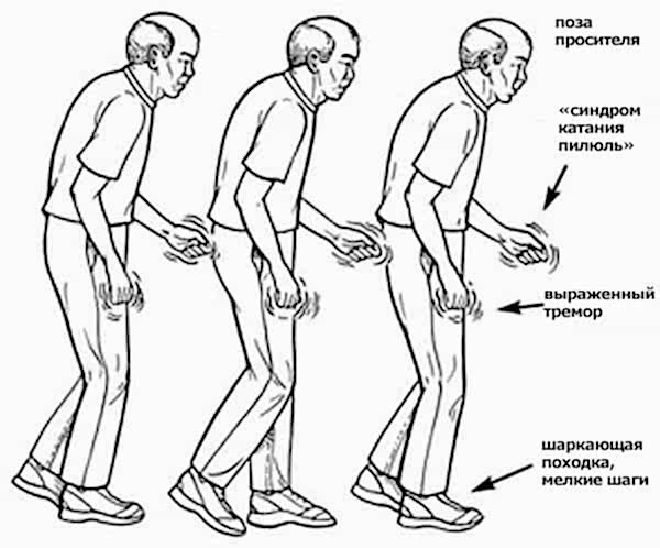 симптомы болезни паркинсона