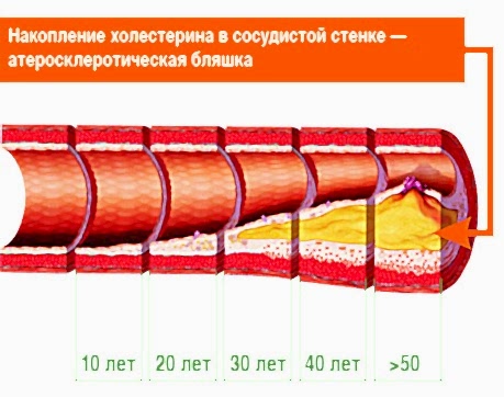 типы атеросклероза