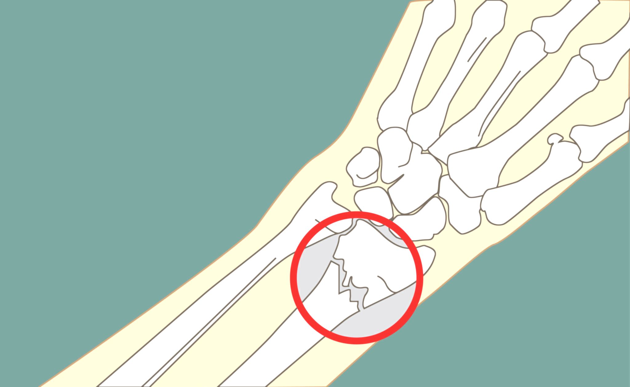 перелом кисти руки