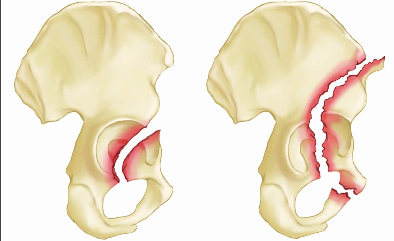 перелом лонной кости