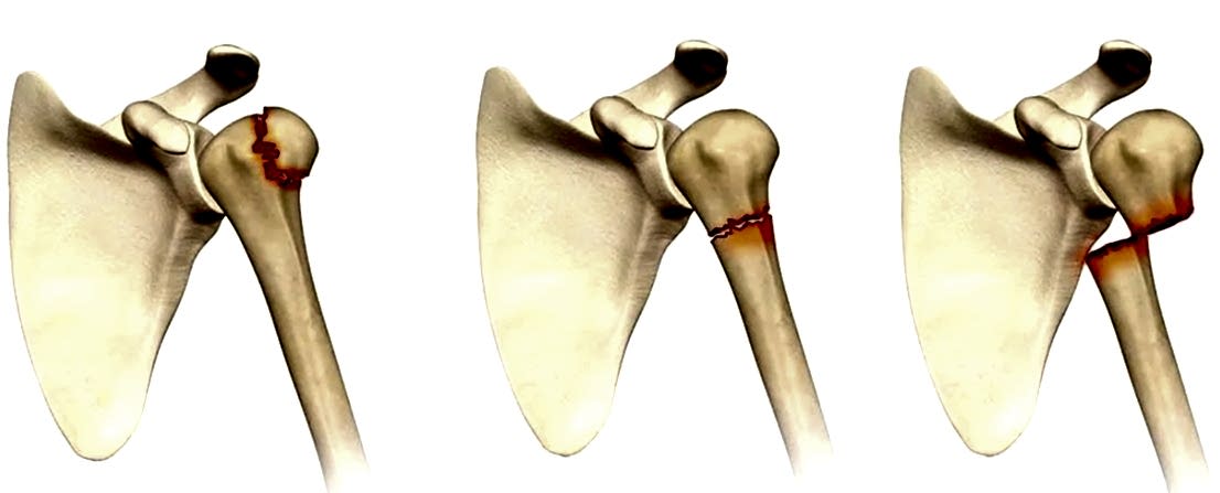 перелом плечевой кости