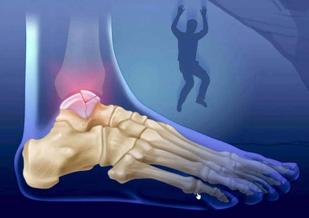 перелом плюсневой кости