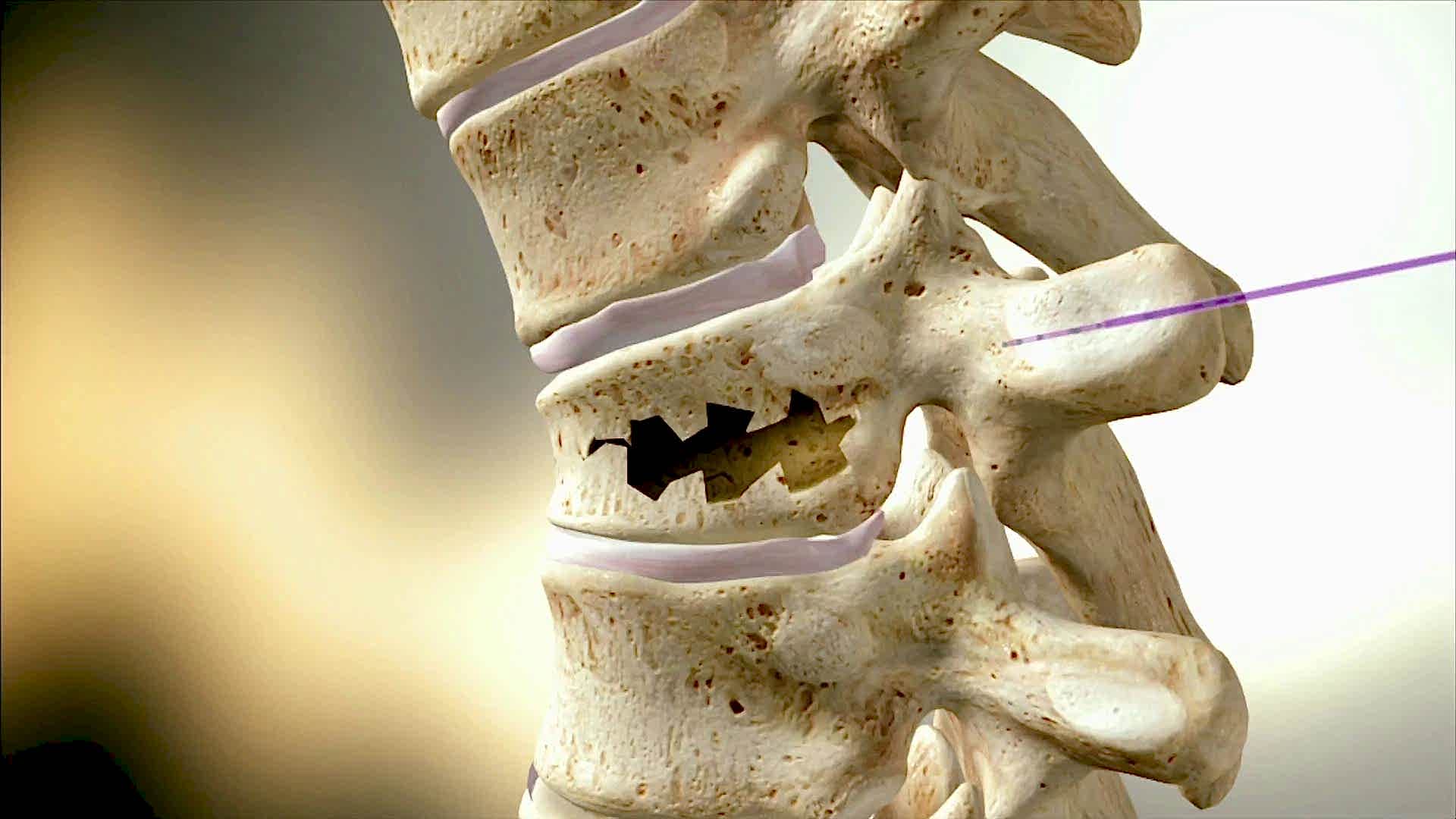 перелом позвоночника