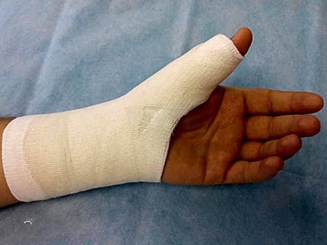 сломанная кисть